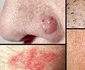 Simptome cancer de piele  Câte tipuri de cancer există, cum se manifestă şi ce tratament se aplică jpeg