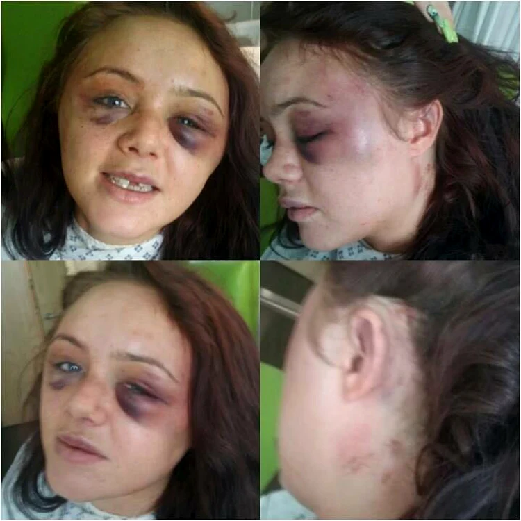 
    Brogan a fost bătută cu bestialitate de iubitul ei, care este luptător de K1foto: NCJ Media  