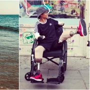 O dansatoare a rămas fără mâini și picioare după ce a fost mușcată de un țânțar în vacanță FOTO Instagram 