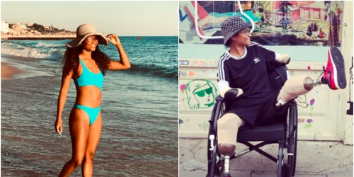 O dansatoare a rămas fără mâini și picioare după ce a fost mușcată de un țânțar în vacanță FOTO Instagram