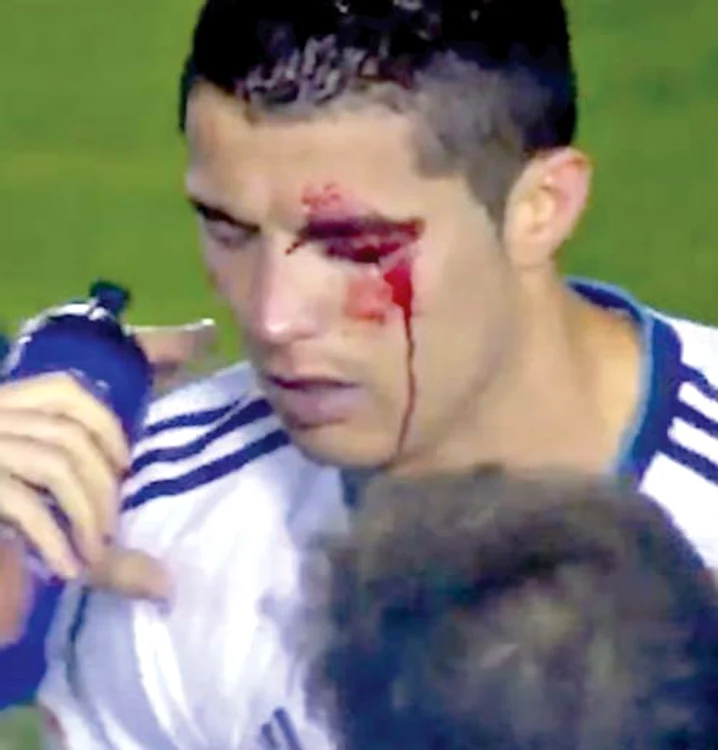 
    Atacantul portughez a  marcat pentru Real Madrid  în meciul cu Levante, în ciuda  faptului că avea vederea  afectată la ambii ochi  