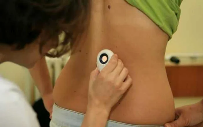Medicii vor examina aluniţele suspecte la consultul dermatologic