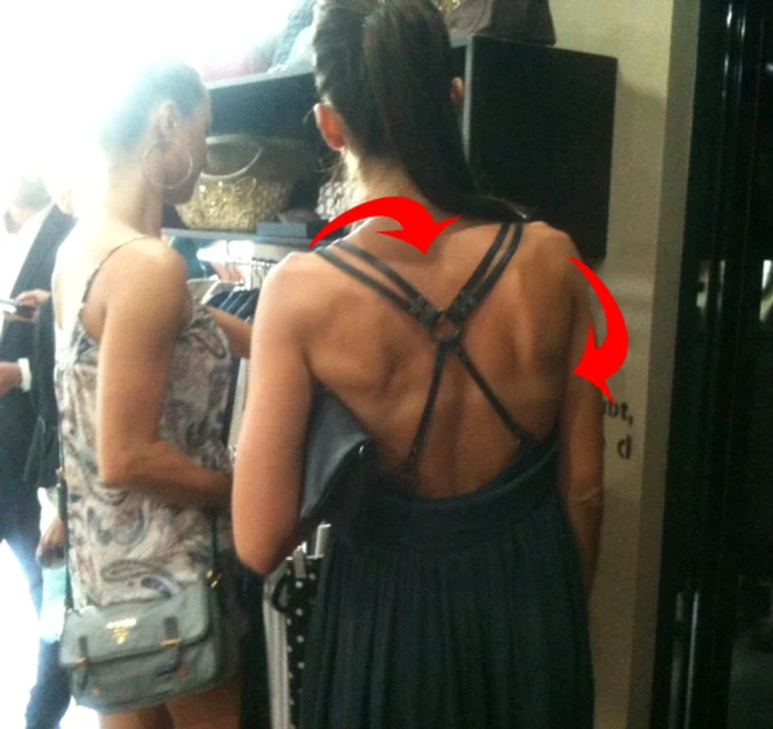 Alina Puşcaş a rămas cu dungi după expunerea la soareFoto: Alina Erimia