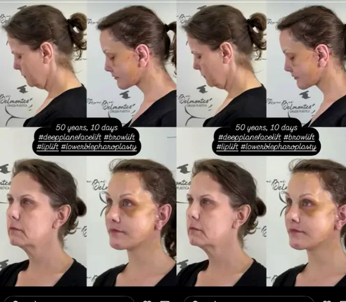Transformarea unei femei i-a lăsat pe internauți cu gura căscată: „I-a șters 20 de ani!” Ea a apelat la lifting facial în Mexic 3 image