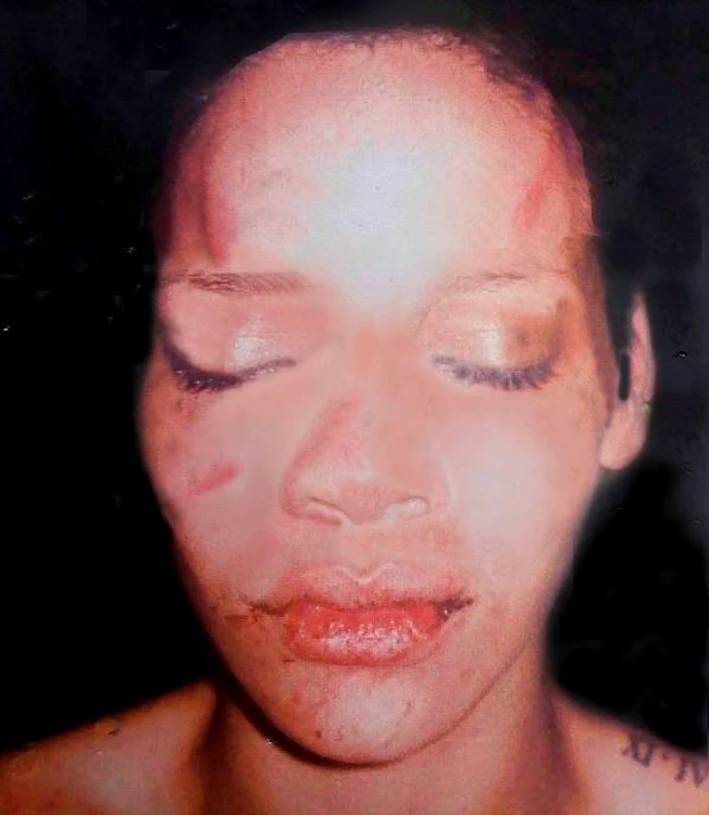 Imaginile cu Rihanna după ce a fost agresată de Brown