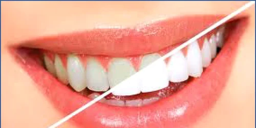 Hollywood Smile