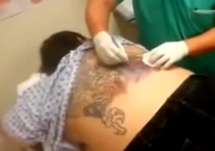 O femeie a făcut o infecție severă din cauza unui tatuaj uriaș pe care și l-a făcut pe spatecaptură: youtube