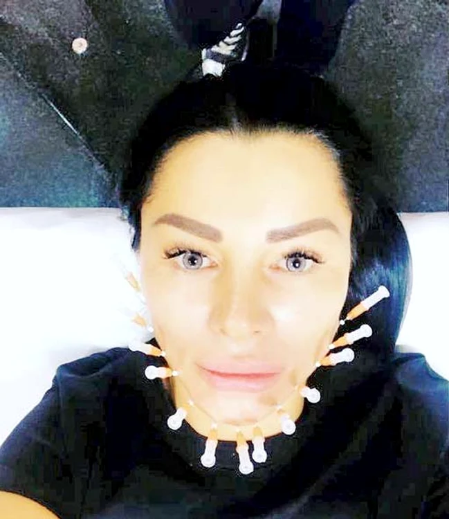 Brigitte Năstase, cu ace înfipte în faţă. Ea s-a filmat şi a pus totul pe Instagram