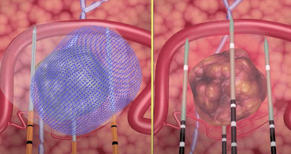 Intervenția inovatoare care poate trata cancerul de prostată într-o oră VIDEO