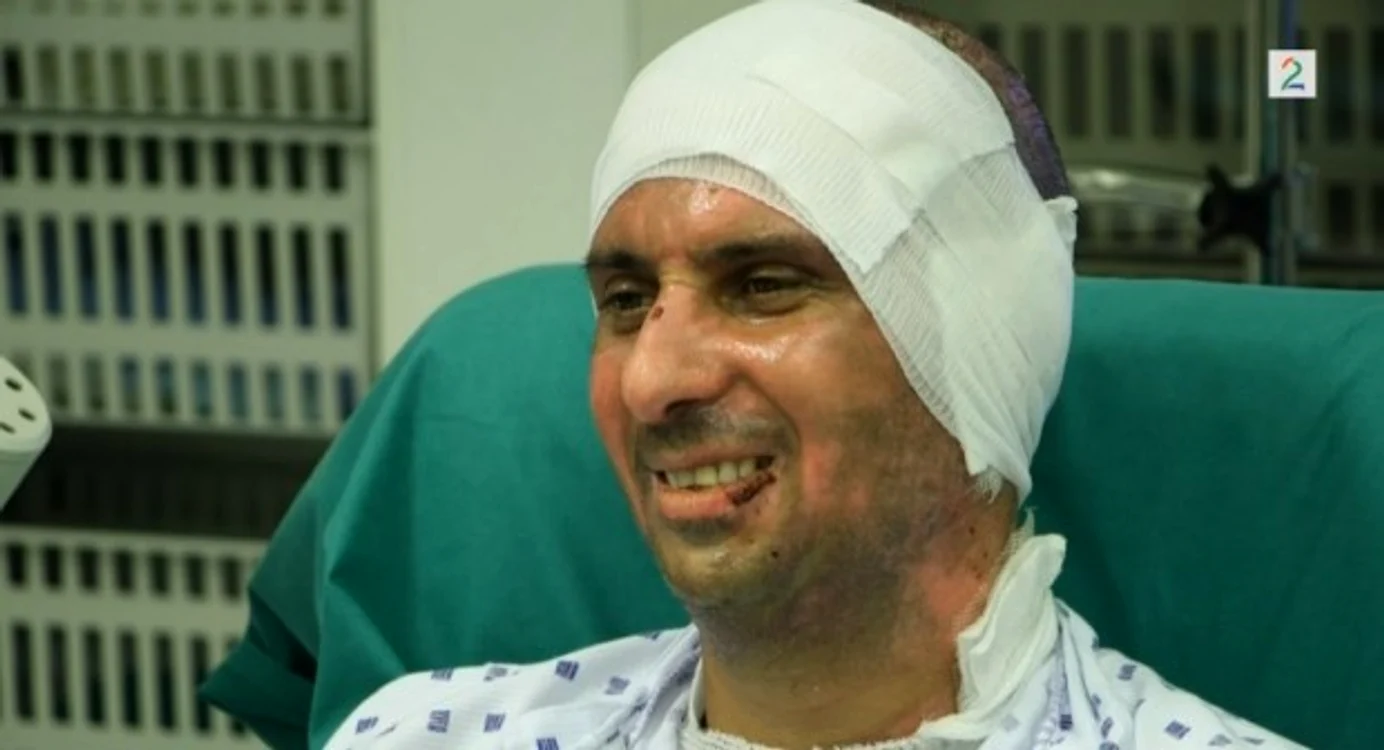 
    Marius (41 de ani) a avut arsuri pe mâini și pe cap  