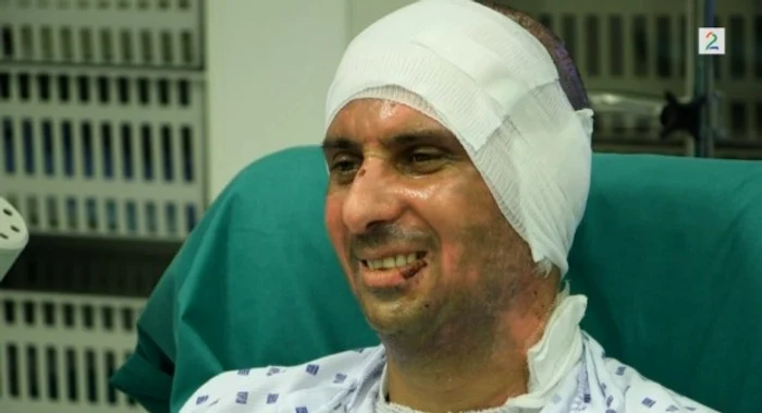 Marius (41 de ani) a avut arsuri pe mâini și pe cap