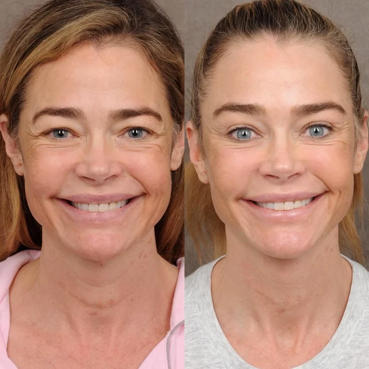 Denise Richards lifting, Foto Instagram (5) jpg