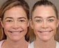 Denise Richards lifting, Foto Instagram