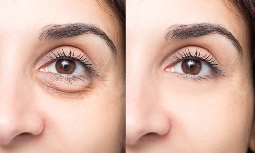 ochi umflați puingi sub ochi jpg