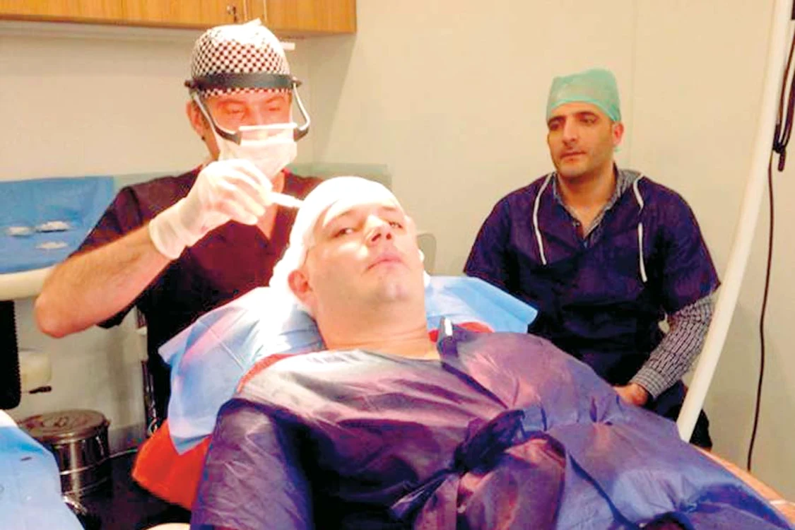 Solistului i-au fost implantate 8.000 de fire de păr la un spital din Turcia