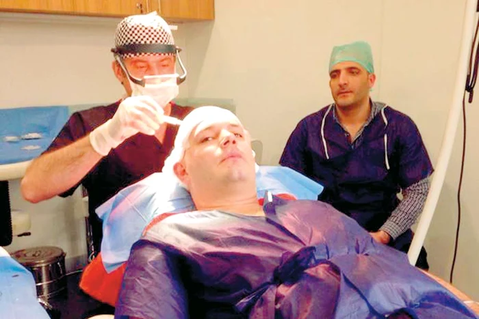 
    Solistului i-au fost  implantate 8.000  de fire de păr la  un spital din Turcia  