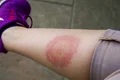 boala Lyme jpg
