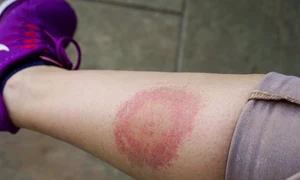 boala Lyme jpg