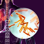 Tuberculoza rămâne boala infecțioasă cu cea mai mare rată de mortalitate din lume Foto Shutterstock 