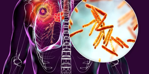 Tuberculoza rămâne boala infecțioasă cu cea mai mare rată de mortalitate din lume Foto Shutterstock 
