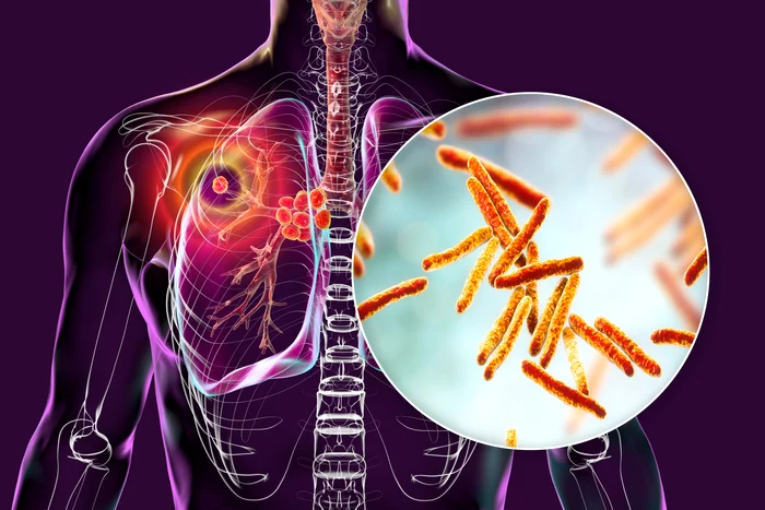Tuberculoza rămâne boala infecțioasă cu cea mai mare rată de mortalitate din lume Foto Shutterstock 