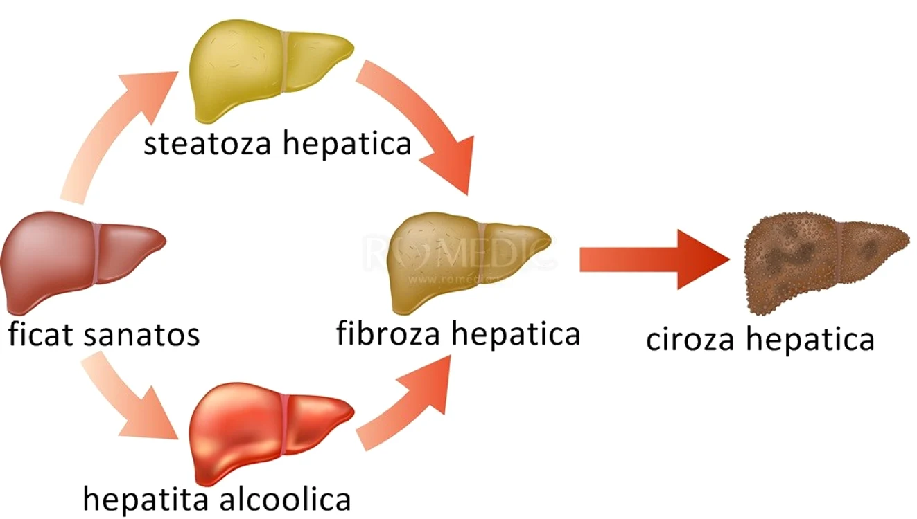 Stadiile cirozei hepatice
