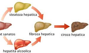 Stadiile cirozei hepatice jpeg