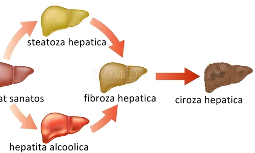 Stadiile cirozei hepatice jpeg