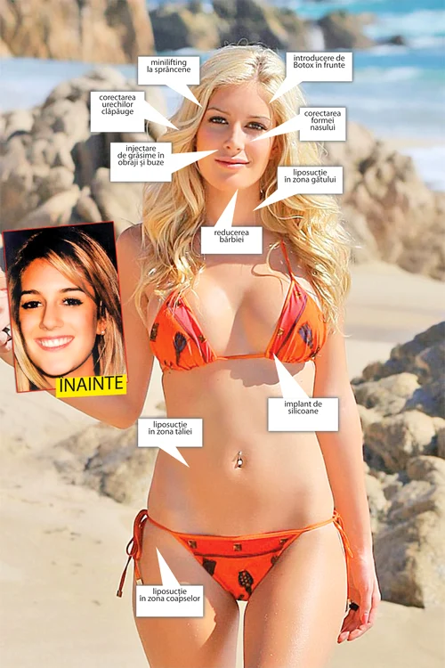 Operaţiile au costat-o pe Heidi 30.000 de dolari