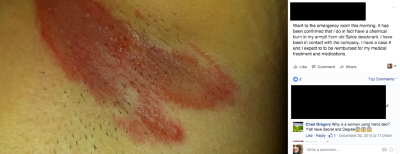 O femeie care a folosit deodorantul a mers la doctor, unde i s-a spus că a suferit arsuri chimice