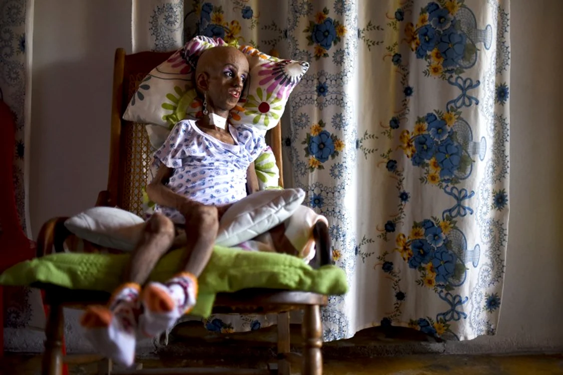 Magali Gonzalez Sierra suferă de o boală rarăfoto: AFP