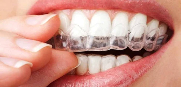 Cât costă un aparat dentar invizibil Acesta îndreaptă dinţii şi previne pierderea lor