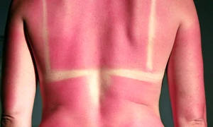 arsuri solare foto shutterstock