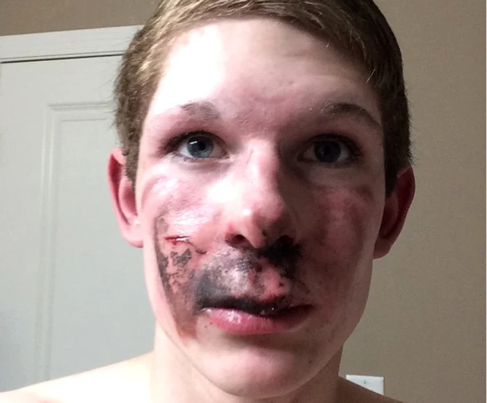 
    Un adolescent din Canada s-a ales cu arsuri grave pe față din cauza unui țigări electronicefoto: captură  