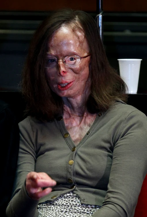 Patricia Lefranc, la doi ani după accident