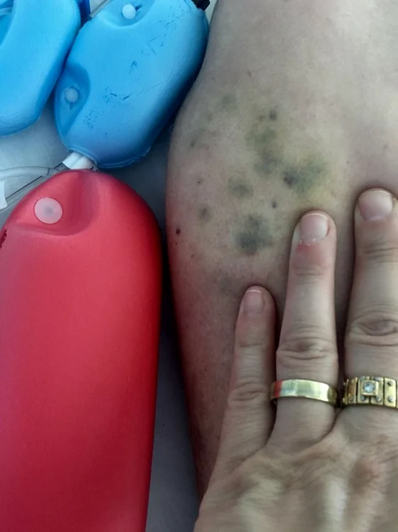 Aşa arată mâna copilului după mai multe înţepături 