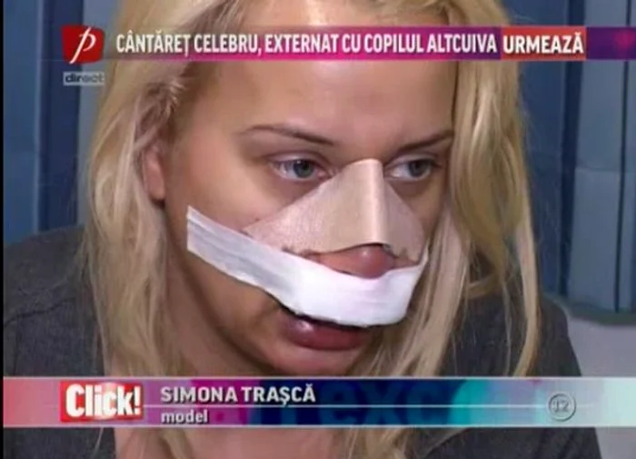 Simona Traşcă îşi va da bandajele jos peste 10 zile