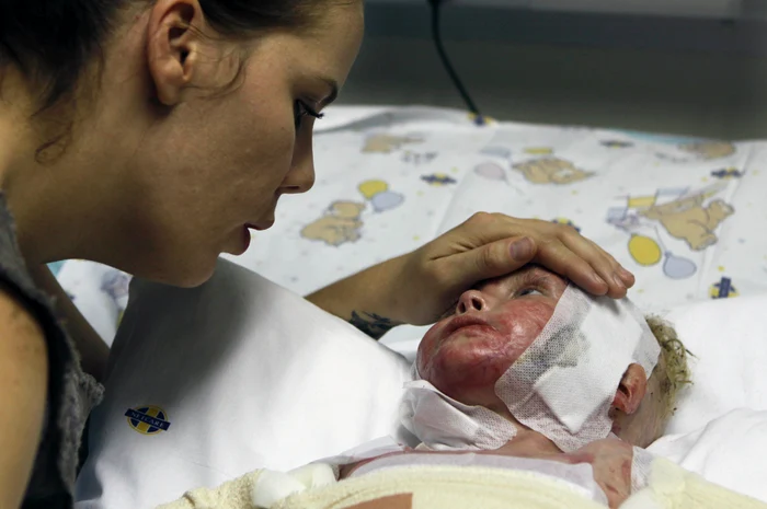 Pippie Kruger a fost arsă pe 80% din corp, la doar 3 ani