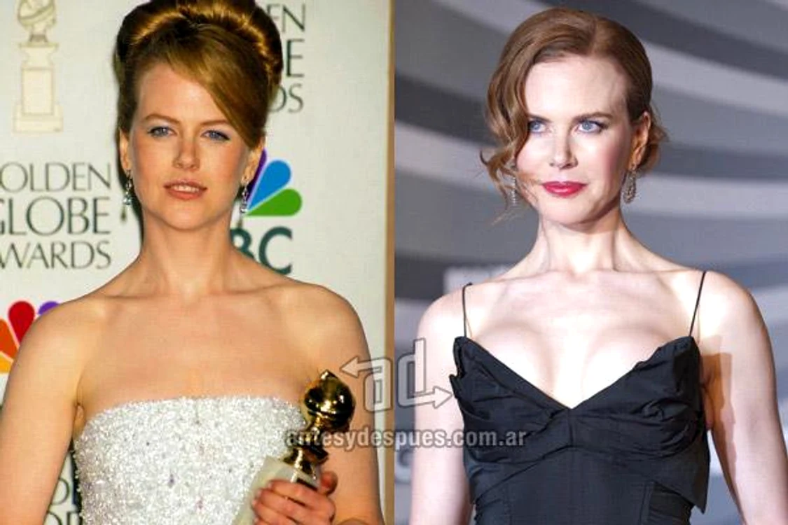 vedete tunate, dive siliconate, nicole kidman