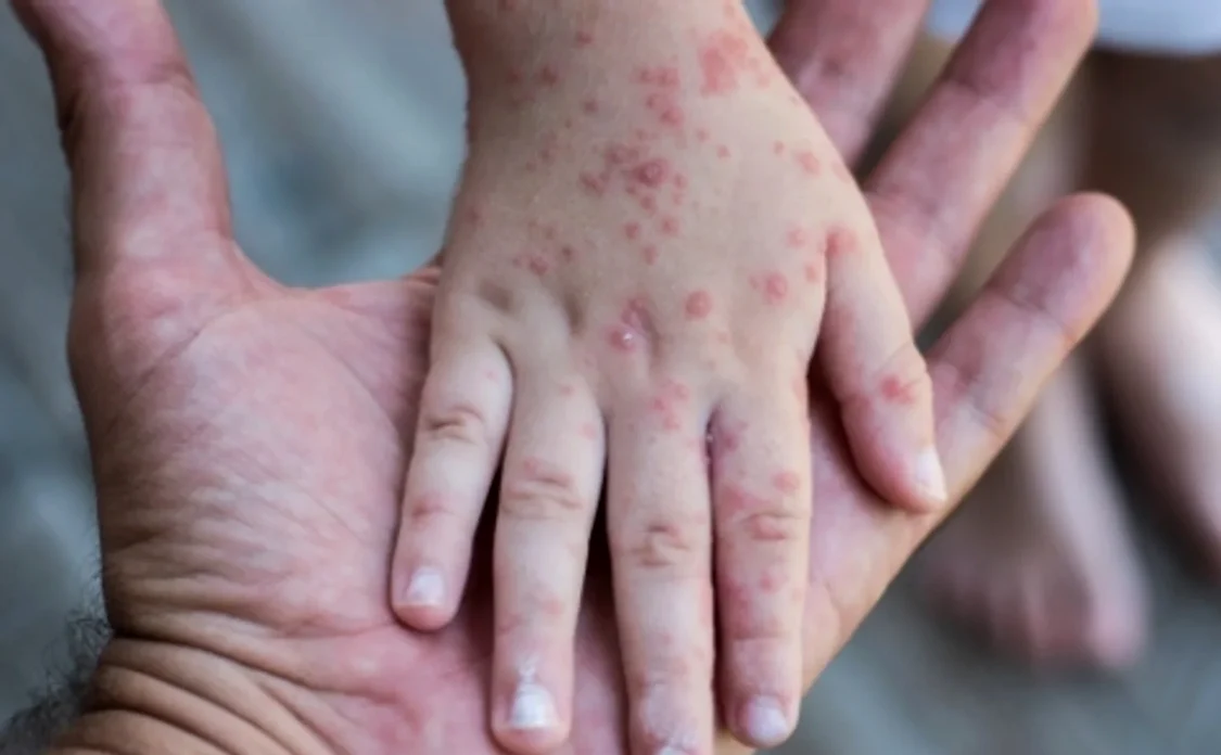 Copiii sunt mai predispuși la infectarea cu virusul Coxsackie FOTO: Ministerul Sănătății din Ucraina