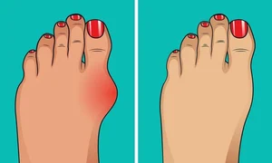 monturi remedii 0 jpeg