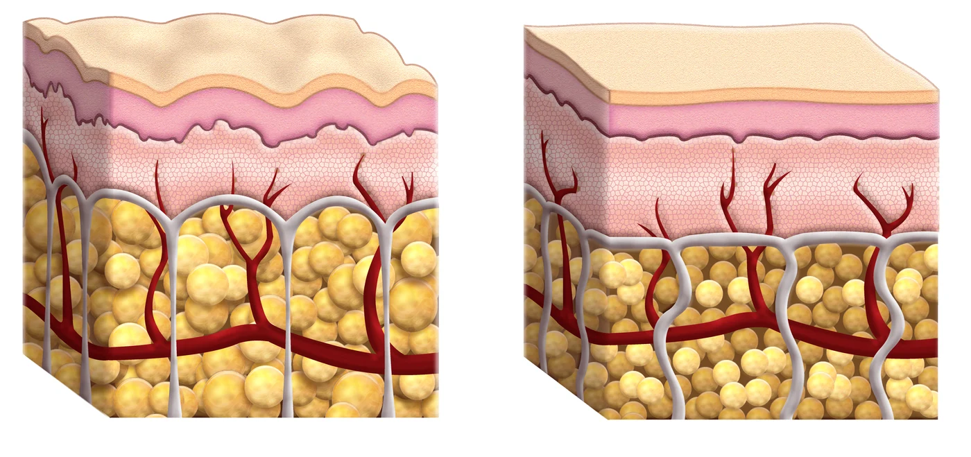 Aşa arată benzile fibroase de sub piele