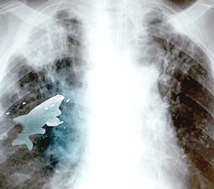 În momentul radiografiei, intrusul încă trăia