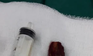 Lemnul a fost scos din maxilarul bărbatului jpeg