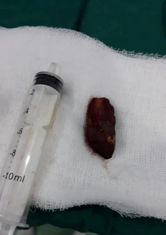 Lemnul a fost scos din maxilarul bărbatului