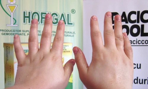 Mâini umflate dimineaţa  Cauze şi remedii pentru această afecţiune jpeg