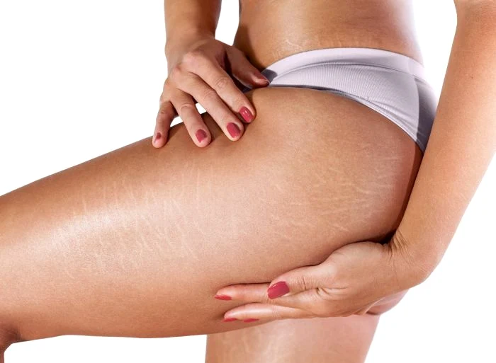 Cremă de casă pentru vergeturi. Rețeta pentru o piele netedă și fermă.