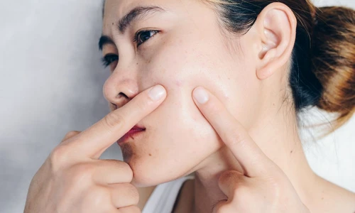 1 tratament natural acnee jpg jpeg