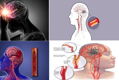 Atacul cerebral vascular reprezintă una dintre principalele cauze de deces în România Colaj  DMS