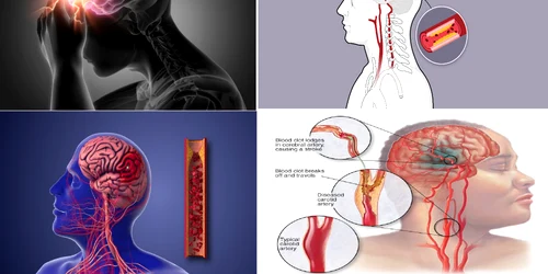 Atacul cerebral vascular reprezintă una dintre principalele cauze de deces în România Colaj  DMS